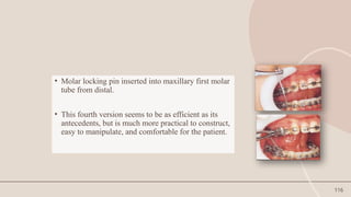 116
• Molar locking pin inserted into maxillary first molar
tube from distal.
• This fourth version seems to be as efficient as its
antecedents, but is much more practical to construct,
easy to manipulate, and comfortable for the patient.
 