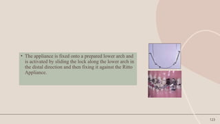 123
• The appliance is fixed onto a prepared lower arch and
is activated by sliding the lock along the lower arch in
the distal direction and then fixing it against the Ritto
Appliance.
 