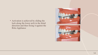 124
• Activation is achieved by sliding the
lock along the lower arch in the distal
direction and then fixing it against the
Ritto Appliance
 