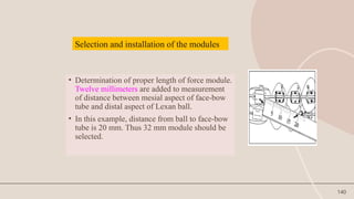 140
• Determination of proper length of force module.
Twelve millimeters are added to measurement
of distance between mesial aspect of face-bow
tube and distal aspect of Lexan ball.
• In this example, distance from ball to face-bow
tube is 20 mm. Thus 32 mm module should be
selected.
Selection and installation of the modules
 