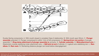 Eureka Spring components. A. With mouth closed in complete Class II relationship. B. With mouth open 50mm. C. Plunger
assembly extended. D. Plunger compressed to within 1mm of full compression. E. Spring-driven ram portion of plunger
assembly. F. Ring-clamp attachment of plunger assembly to archwire. G. Cylinder assembly. H. Molarattachment wire. I.
Elastomeric module stabilizing molar attachment wire. J. Ball joint at end of cylinder. K. Ligature wire stabilizing ram. L. Ram
elbow. M. Ram neck. N. Remaining distance plunger can travel before disengagement
DeVincenzo JP. The Eureka Spring™: a compact, versatile, and cost-effective Class II corrector. Orthodontic Treatment of the Class II Noncompliant Patient: Current
 