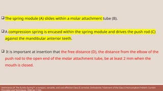 The spring module (A) slides within a molar attachment tube (B).
A compression spring is encased within the spring module and drives the push rod (C)
against the mandibular anterior teeth.
 It is important at insertion that the free distance (D), the distance from the elbow of the
push rod to the open end of the molar attachment tube, be at least 2 mm when the
mouth is closed.
DeVincenzo JP. The Eureka Spring™: a compact, versatile, and cost-effective Class II corrector. Orthodontic Treatment of the Class II Noncompliant Patient: Current
Principles and Techniques. 2006 Jan 1:163.
 