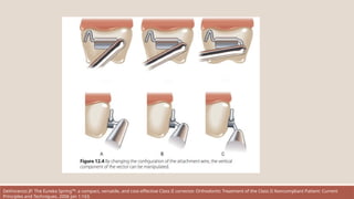 DeVincenzo JP. The Eureka Spring™: a compact, versatile, and cost-effective Class II corrector. Orthodontic Treatment of the Class II Noncompliant Patient: Current
Principles and Techniques. 2006 Jan 1:163.
 