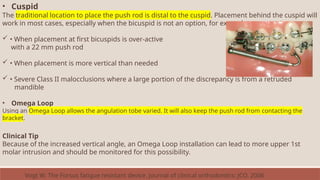 • Cuspid
The traditional location to place the push rod is distal to the cuspid. Placement behind the cuspid will
work in most cases, especially when the bicuspid is not an option, for example:
 • When placement at first bicuspids is over-active
with a 22 mm push rod
 • When placement is more vertical than needed
 • Severe Class II malocclusions where a large portion of the discrepancy is from a retruded
mandible
• Omega Loop
Using an Omega Loop allows the angulation tobe varied. It will also keep the push rod from contacting the
bracket.
Clinical Tip
Because of the increased vertical angle, an Omega Loop installation can lead to more upper 1st
molar intrusion and should be monitored for this possibility.
Vogt W. The Forsus fatigue resistant device. Journal of clinical orthodontics: JCO. 2006
 