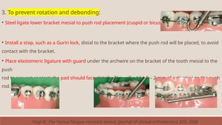 3. To prevent rotation and debonding:
• Steel ligate lower bracket mesial to push rod placement (cuspid or bicuspid).
• Install a stop, such as a Gurin lock, distal to the bracket where the push rod will be placed, to avoid
contact with the bracket.
• Place elastomeric ligature with guard under the archwire on the bracket of the tooth mesial to the
push
rod to prevent contact; the pad should face distally. This will add 1.5 – 2 mm of activation to the push
rod.
Vogt W. The Forsus fatigue resistant device. Journal of clinical orthodontics: JCO. 2006
 