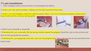  L-pin Installation
1. Clear headgear tube to ensure there is no blockage from debris.
2. Insert L-pin into spring module, making sure the ball is positioned buccally.
3. Insert L-pin into headgear tube from distal tomesial. Allow 1 to 2 mm of clearance between distal end of
buccal tube and the universal spring eyelet.
4. Bend L-pin occlusally or gingivally.
• If bending the L-pin occlusally, flip the spring module toward the gingival, bend the L-pin to the occlusal and
then let the spring fall into position.
• If bending the L-pin gingivally, bend the L-pin over the gingival tube. The L-pin can also be secured behind the
elastic hook.
Vogt W. The Forsus fatigue resistant device. Journal of clinical orthodontics: JCO. 2006
 