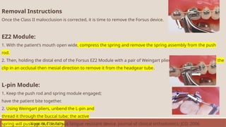Removal Instructions
Once the Class II malocclusion is corrected, it is time to remove the Forsus device.
EZ2 Module:
1. With the patient’s mouth open wide, compress the spring and remove the spring assembly from the push
rod.
2. Then, holding the distal end of the Forsus EZ2 Module with a pair of Weingart pliers, pull the distal end of the
clip in an occlusal then mesial direction to remove it from the headgear tube.
L-pin Module:
1. Keep the push rod and spring module engaged;
have the patient bite together.
2. Using Weingart pliers, unbend the L-pin and
thread it through the buccal tube; the active
spring will push pin out distally.
Vogt W. The Forsus fatigue resistant device. Journal of clinical orthodontics: JCO. 2006
 
