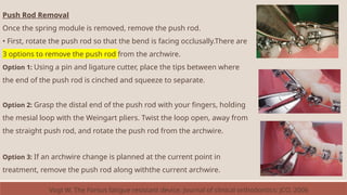 Push Rod Removal
Once the spring module is removed, remove the push rod.
• First, rotate the push rod so that the bend is facing occlusally.There are
3 options to remove the push rod from the archwire.
Option 1: Using a pin and ligature cutter, place the tips between where
the end of the push rod is cinched and squeeze to separate.
Option 2: Grasp the distal end of the push rod with your fingers, holding
the mesial loop with the Weingart pliers. Twist the loop open, away from
the straight push rod, and rotate the push rod from the archwire.
Option 3: If an archwire change is planned at the current point in
treatment, remove the push rod along withthe current archwire.
Vogt W. The Forsus fatigue resistant device. Journal of clinical orthodontics: JCO. 2006
 