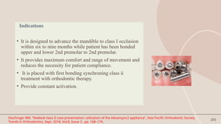 205
Indications
• It is designed to advance the mandible to class I occlusion
within six to nine months while patient has been bonded
upper and lower 2nd premolar to 2nd premolar.
• It provides maximum comfort and range of movement and
reduces the necessity for patient compliance.
• It is placed with first bonding synchroning class ii
treatment with orthodontic therapy.
• Provide constant activation.
Dischinger BM, “Skeletal class II case presentation: utilization of the Advansync2 appliance”, Asia Pacific Orthodontic Society
Trends in Orthodontics, Sept. 2018, Vol.8, Issue 3 , pp. 168–174.
 