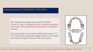 37
Anchorage forms OF THE HERBST APPLIANCE
The standard anchorage system used by Herbst:
Crowns or caps were placed on the maxillary permanent
first molars and mandibular first premolars (sometimes
canines).
The crowns/caps were joined by half round wires (1.5 x
0.75 mm) that run along the palatal surfaces of the upper
teeth and the lingual surfaces of the lower teeth.
Pancherz H, Hansen K. Mandibular anchorage in Herbst treatment. European Journal of Orthodontics. 1988 May 1;10(2):149-64.
 