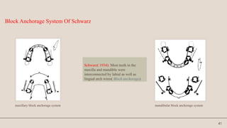 41
Schwarz( 1934): Most teeth in the
maxilla and mandible were
interconnected by labial as well as
lingual arch wires( Block anchorage)
Block Anchorage System Of Schwarz
maxillary block anchorage system mandibular block anchorage system
 