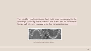 44
The maxillary and mandibular front teeth were incorporated in the
anchorage system by labial sectional arch wires, and the mandibular
lingual arch wire was extended to the first permanent molars.
The increased anchorage system of Pancherz
 