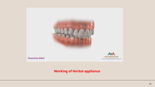 45
Working of Herbst appliance
 