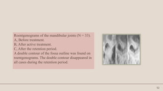 52
Roentgenograms of the mandibular joints (N = 33).
A, Before treatment.
B, After active treatment.
C, After the retention period.
A double contour of the fossa outline was found on
roentgenograms. The double contour disappeared in
all cases during the retention period.
 