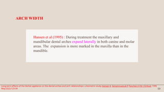 59
Hansen et al (1995) : During treatment the maxillary and
mandibular dental arches expand laterally in both canine and molar
areas. The expansion is more marked in the maxilla than in the
mandible.
ARCH WIDTH
Long-term effects of the Herbst appliance on the dental arches and arch relationships: a biometric study.Hansen K, Iemamnueisuk P Pancherz H Br J Orthod. 1995
May;22(2):123-34
 