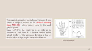 65
The greatest amount of sagittal condylar growth was
found in subjects treated at the skeletal maturity
stage MP3-FG, which occurs close to the peak
growth period.
Stage MP3-FG: the epiphysis is as wide as its
metaphysis, and there is a distinct medial and/or
lateral border of the epiphysis forming a line of
demarcation at right angles to the distal border.
Hagg and Taranger
 
