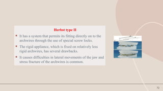 72
Herbst type II
 It has a system that permits its fitting directly on to the
archwires through the use of special screw locks.
 The rigid appliance, which is fixed on relatively less
rigid archwires, has several drawbacks.
 It causes difficulties in lateral movements of the jaw and
stress fracture of the archwires is common.
 