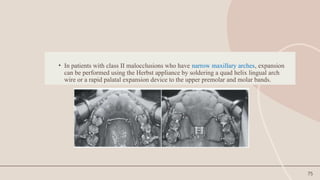 75
• In patients with class II malocclusions who have narrow maxillary arches, expansion
can be performed using the Herbst appliance by soldering a quad helix lingual arch
wire or a rapid palatal expansion device to the upper premolar and molar bands.
 