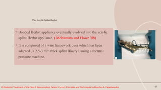 81
The Acrylic Splint Herbst
• Bonded Herbst appliance eventually evolved into the acrylic
splint Herbst appliance. ( McNamara and Howe ’88)
• It is composed of a wire framework over which has been
adapted , a 2.5-3 mm thick splint Biocryl, using a thermal
pressure machine.
Orthodontic Treatment of the Class II Noncompliant Patient: Current Principles and Techniques by Moschos A. Papadopoulos
 