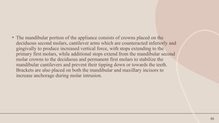 86
• The mandibular portion of the appliance consists of crowns placed on the
deciduous second molars, cantilever arms which are counteracted inferiorly and
gingivally to produce increased vertical force, with stops extending to the
primary first molars, while additional stops extend from the mandibular second
molar crowns to the deciduous and permanent first molars to stabilize the
mandibular cantilevers and prevent their tipping down or towards the teeth.
Brackets are also placed on both the mandibular and maxillary incisors to
increase anchorage during molar intrusion.
 