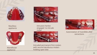 88
Maxillary
appliance
Mandibular
appliance
Intrusion herbst
engaged to intrude
molar
Intruded permanent first molars
with second deciduous molars
holding open bite
Autorotation of mandible after
extractions
 