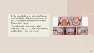 91
• In the mandibular arch, a 2mm half round
cantilver is placed between the first molar
and the interproximal area between first
bicuspid and cuspid.
• The axle is placed at mesial end of
cantilever, and .022" x .028" archwire tube
is placed above and below axle.
 