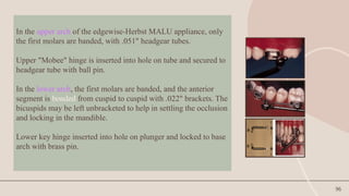 96
In the upper arch of the edgewise-Herbst MALU appliance, only
the first molars are banded, with .051" headgear tubes.
Upper "Mobee" hinge is inserted into hole on tube and secured to
headgear tube with ball pin.
In the lower arch, the first molars are banded, and the anterior
segment is bonded from cuspid to cuspid with .022" brackets. The
bicuspids may be left unbracketed to help in settling the occlusion
and locking in the mandible.
Lower key hinge inserted into hole on plunger and locked to base
arch with brass pin.
 
