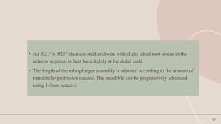 97
• An .021" x .025" stainless steel archwire with slight labial root torque in the
anterior segment is bent back tightly at the distal ends.
• The length of the tube-plunger assembly is adjusted according to the amount of
mandibular protrusion needed. The mandible can be progressively advanced
using 1-5mm spacers.
 