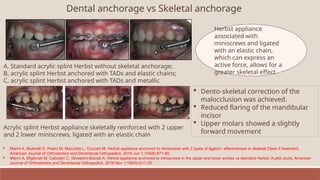 Dental anchorage vs Skeletal anchorage
A, Standard acrylic splint Herbst without skeletal anchorage;
B, acrylic splint Herbst anchored with TADs and elastic chains;
C, acrylic splint Herbst anchored with TADs and metallic
Herbst appliance
associated with
miniscrews and ligated
with an elastic chain,
which can express an
active force, allows for a
greater skeletal effect
Acrylic splint Herbst appliance skeletally reinforced with 2 upper
and 2 lower miniscrews, ligated with an elastic chain
 Dento-skeletal correction of the
malocclusion was achieved.
 Reduced flaring of the mandibular
incisor
 Upper molars showed a slightly
forward movement
 Manni A, Mutinelli S, Pasini M, Mazzotta L, Cozzani M. Herbst appliance anchored to miniscrews with 2 types of ligation: effectiveness in skeletal Class II treatment.
American Journal of Orthodontics and Dentofacial Orthopedics. 2016 Jun 1;149(6):871-80.
 Manni A, Migliorati M, Calzolari C, Silvestrini-Biavati A. Herbst appliance anchored to miniscrews in the upper and lower arches vs standard Herbst: A pilot study. American
Journal of Orthodontics and Dentofacial Orthopedics. 2019 Nov 1;156(5):617-25.
 