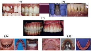 Fp3 Rp4 Fixed implant treatment options in edentulous patients.pptx