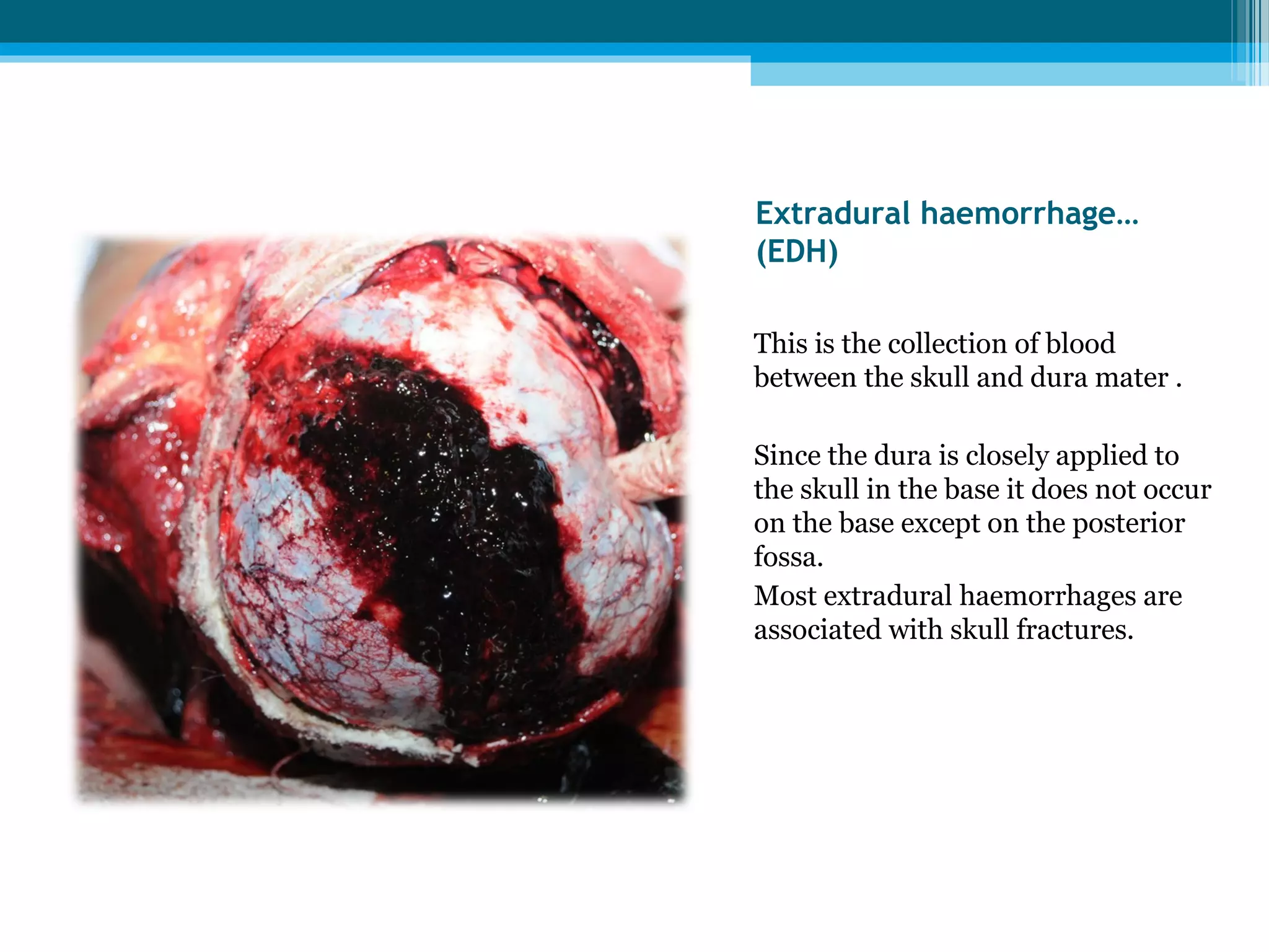 Extradural haemorrhage… 
(EDH) 
This is the collection of blood 
between the skull and dura mater . 
Since the dura is closely applied to 
the skull in the base it does not occur 
on the base except on the posterior 
fossa. 
Most extradural haemorrhages are 
associated with skull fractures. 
 