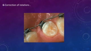 Rickinator Fixed orthodontic appliances | PPTX