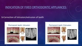 4- Overbite / overjet reduction .
5-Multiple tooth movement .
 