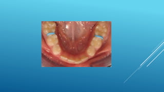 Fixed orthodontic appliances