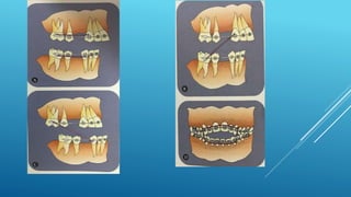 Fixed orthodontic appliances