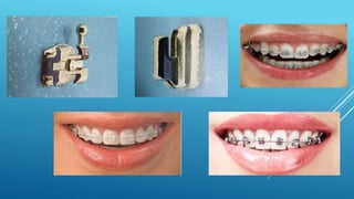Fixed orthodontic appliances