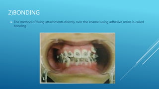 Fixed orthodontic appliances
