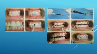 Fixed orthodontic appliances