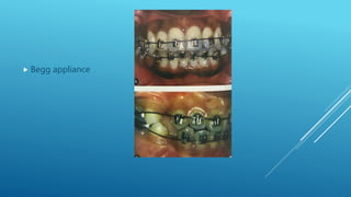 Fixed orthodontic appliances