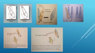 Fixed orthodontic appliances
