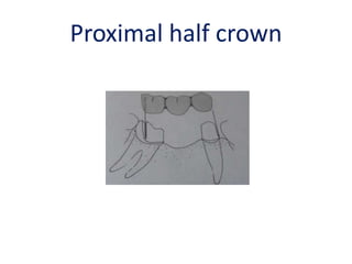 Proximal half crown
 