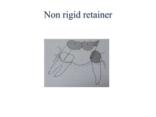 Non rigid retainer
 
