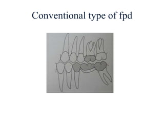 Conventional type of fpd
 