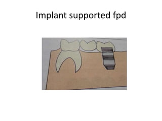 Implant supported fpd
 