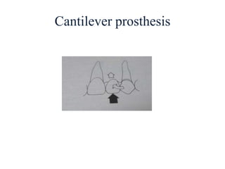Cantilever prosthesis
 