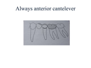 Always anterior cantelever
 