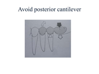 Avoid posterior cantilever
 