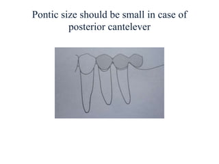 Pontic size should be small in case of
posterior cantelever
 
