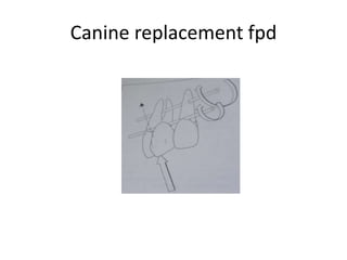 Canine replacement fpd
 