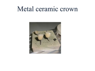 Metal ceramic crown
 